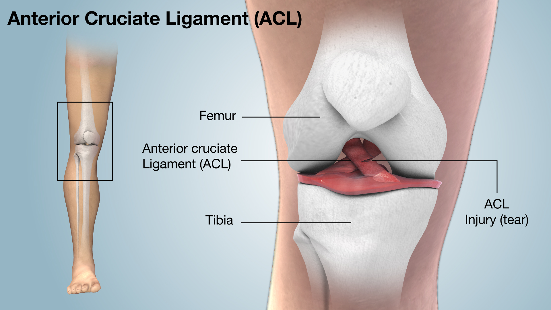 ACL Injury