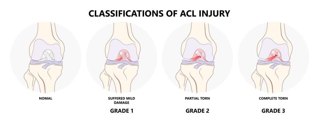 Classification of ACl Injury